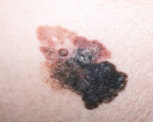 melanoma